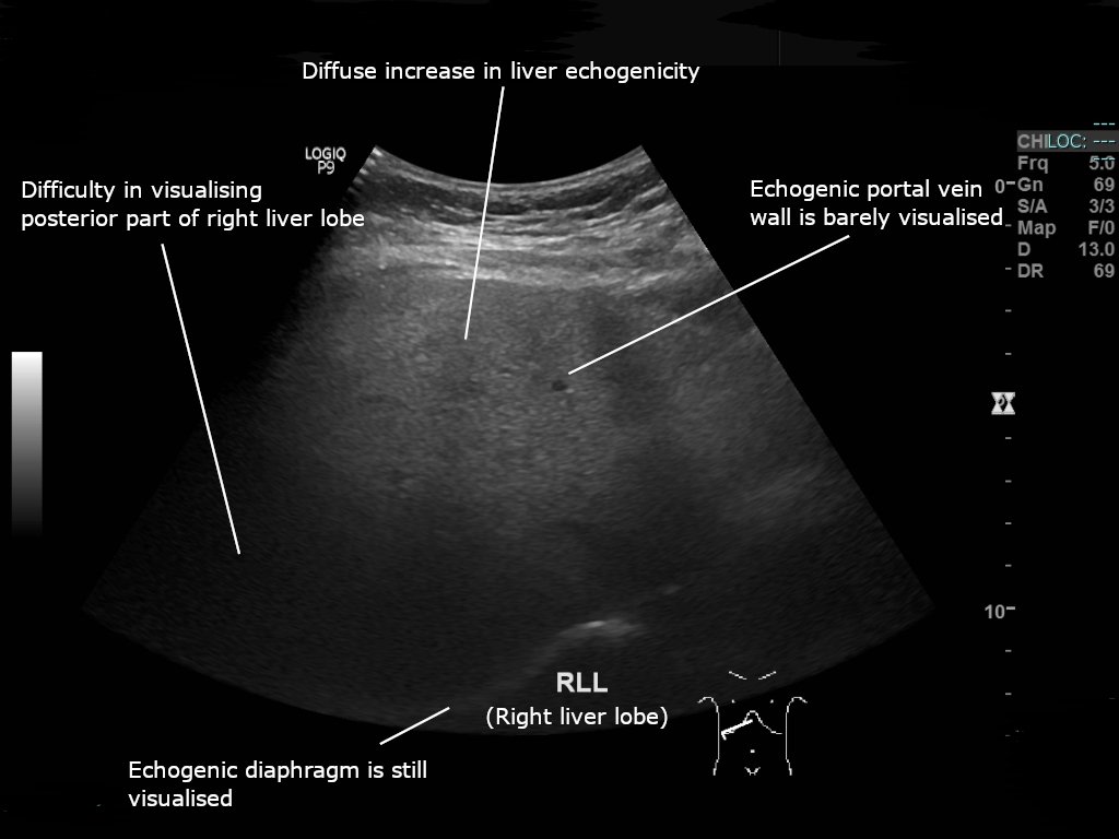 Imagen contextual de archivo: ecografía que muestra un hígado con signos compatibles con esteatosis hepática.